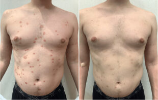 Salicylic acid