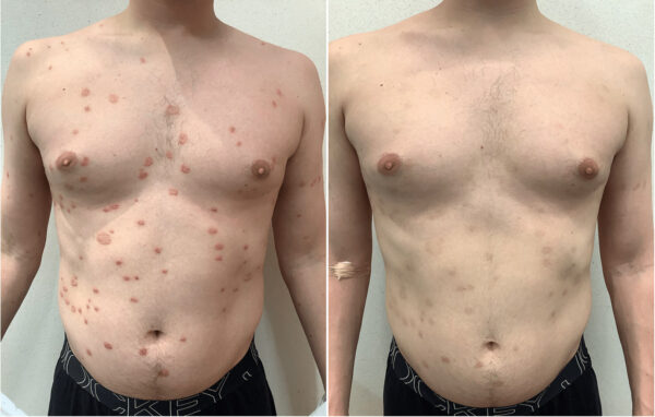 Salicylic acid