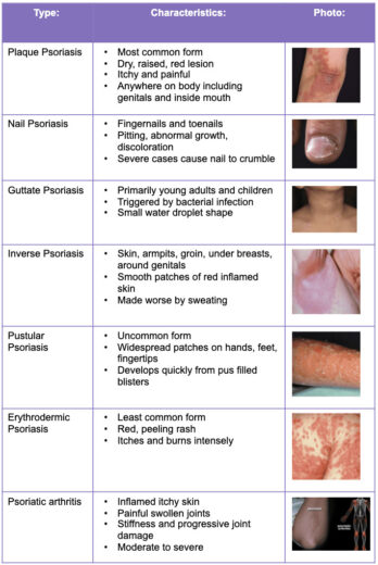 Psoriasis Cream