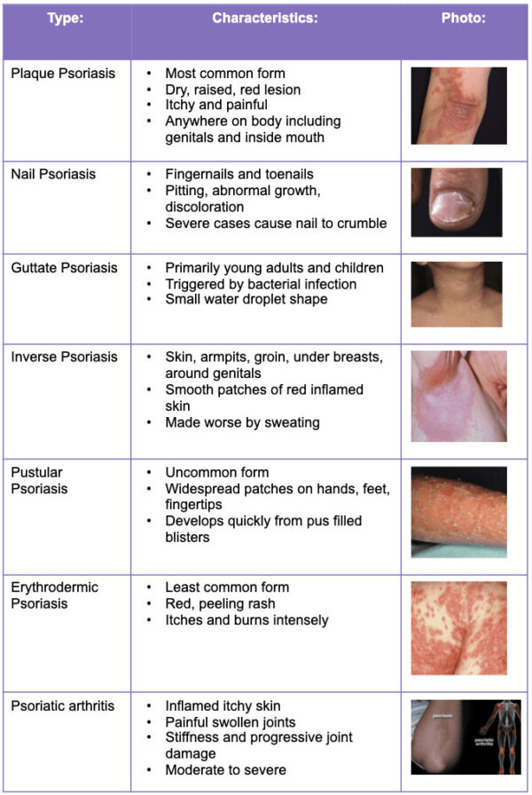 Psoriasis Cream