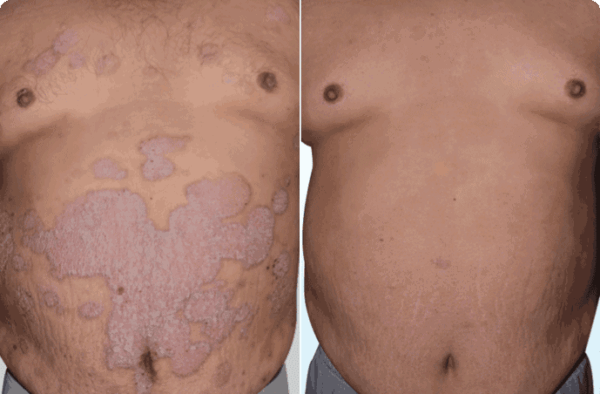 Eczema Cream