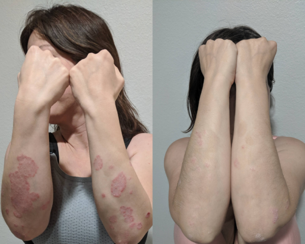 Best Psoriasis Cream in 2026: How to Choose One That Works